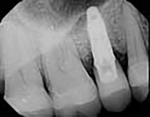 tulsa dental implant
