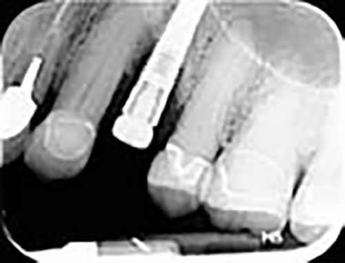 tulsa dental implant